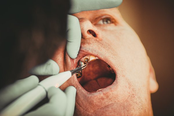 Adieu aux caries dentaires: solutions efficaces et conseils préventifs incontournables